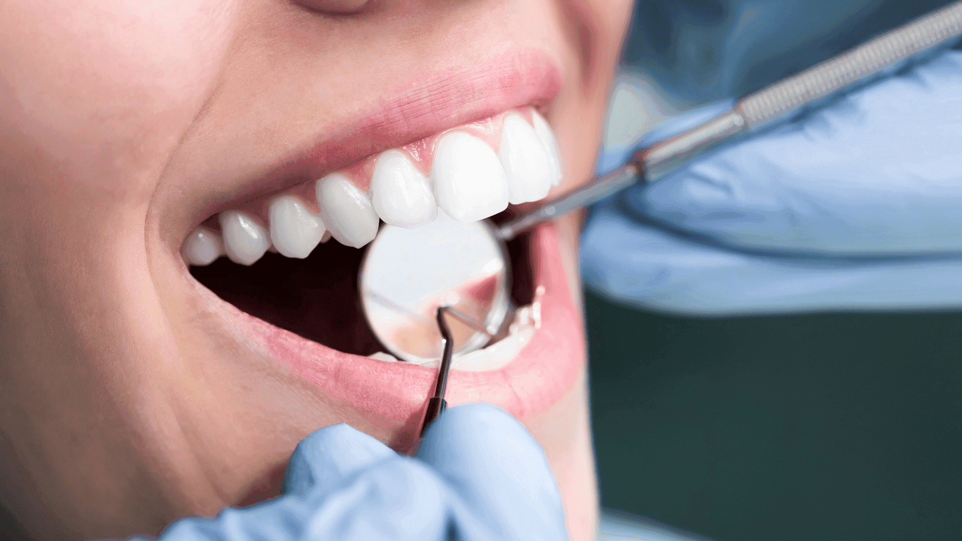 Periodontologia - leczenie chorób przyzębia